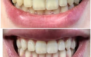 Up and down comparison of teeth whitening results at Pike District Smiles.