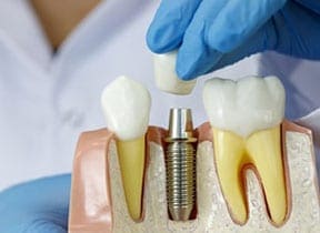 Model demonstrating dental implant procedure with a tooth placed on a couple of teeth at Pike District Smiles.