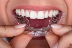 Invisalign A patient applying invisalign on her teeth at Pike district Smiles