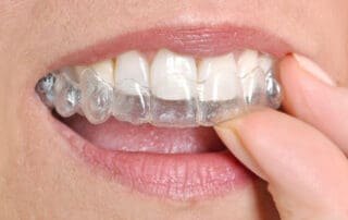 Patient placing Invisalign aligner on her teeth.