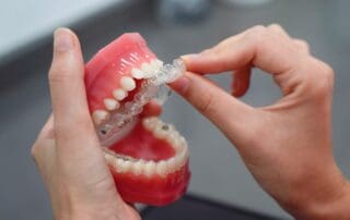 Invisalign aligners being applied to a teeth dummy.