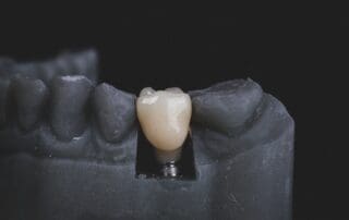 Real tooth placed in a facial dummy to demonstrate its importance.