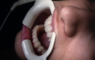 Mouth opener device placed in the patient's mouth, revealing the teeth.